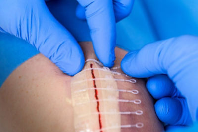 Zip Skin Closure | Stryker